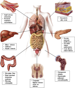 What body parts are affected? – CF Physio